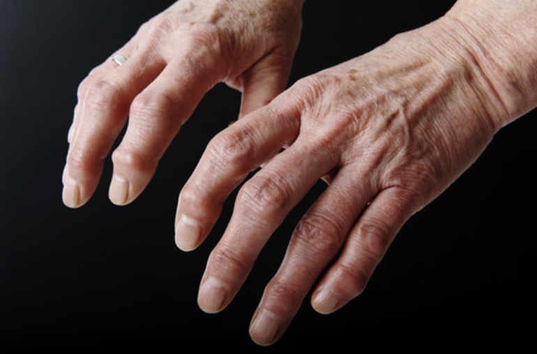 Osteoarthritis Epidemic: One Billion People at Risk by 2050, Warns New ...